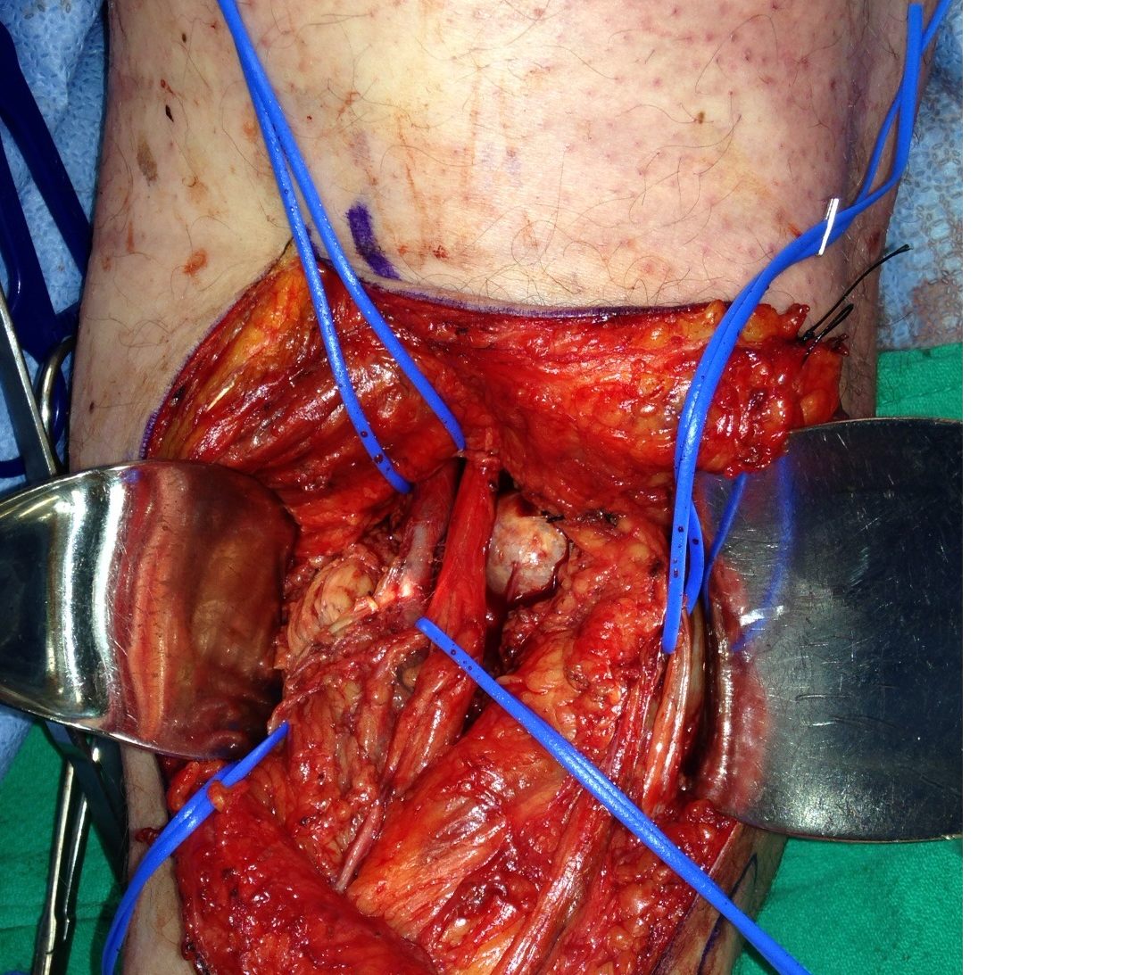 Posterior approach to knee